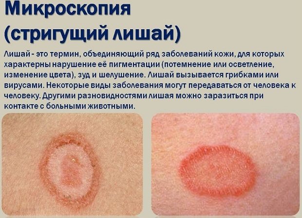 Микроспория у детей (лишай). Фото, лечение гладкой кожи, волосистой части головы, симптомы, инкубационный период, карантин