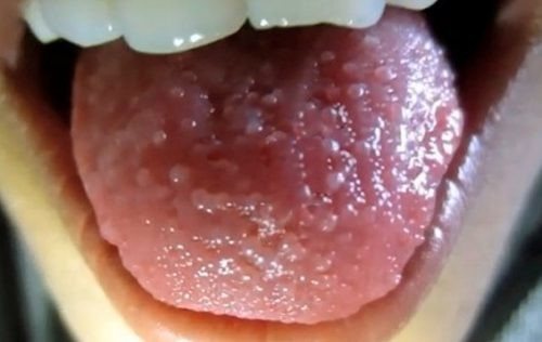 Прыщики на языке